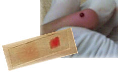 Imagen de plaqueta sangre