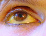 Hepatitis: pandemia silenciosa y de alta resistencia en México